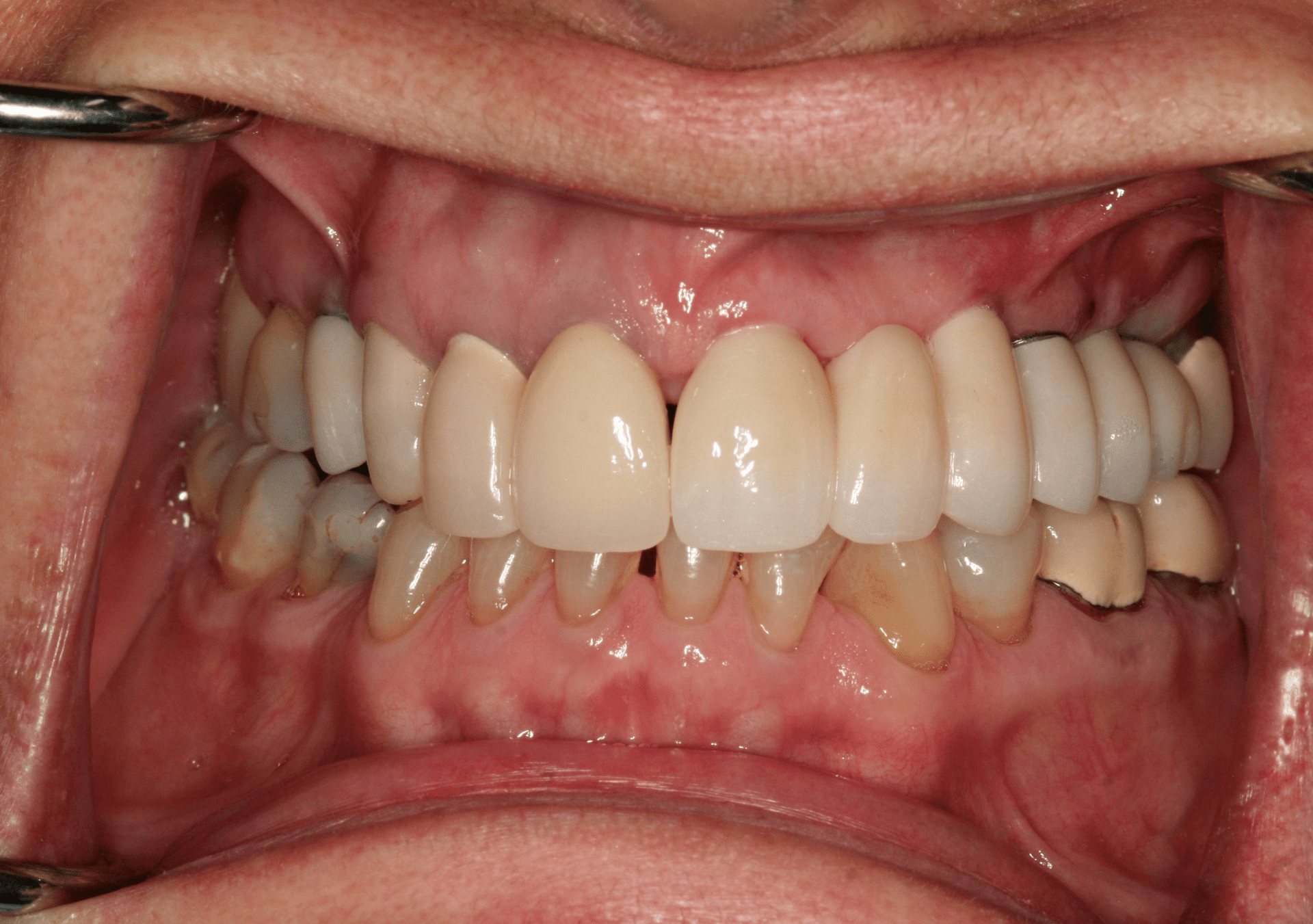 Dental Implants Case 1