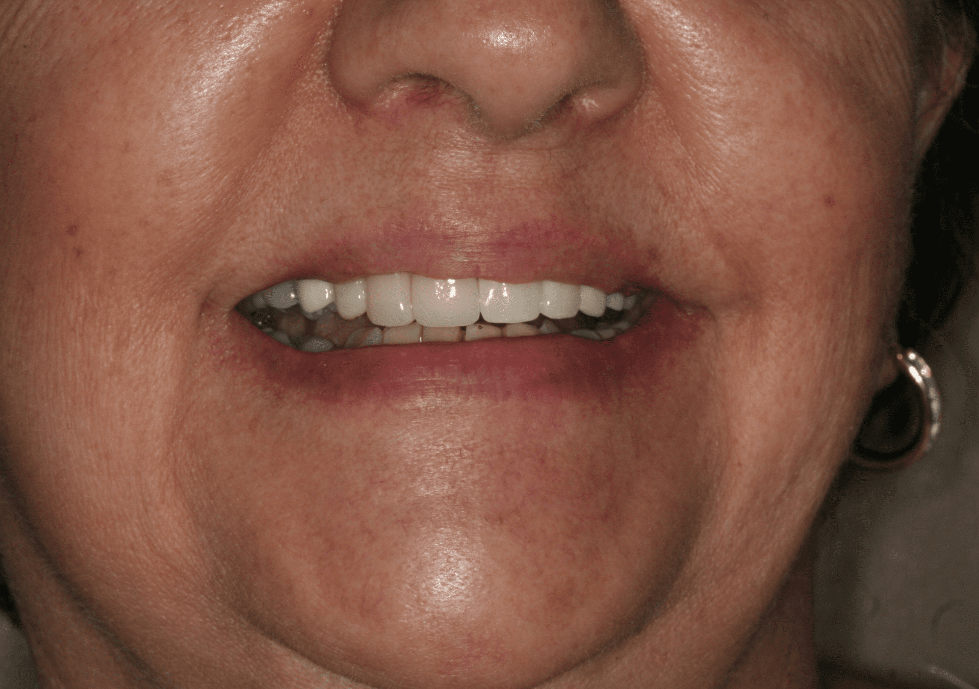 Dental Implants Case 1