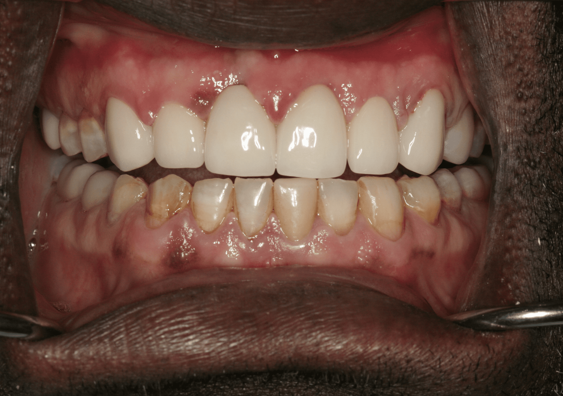 Oral Rehabilitation Case 1