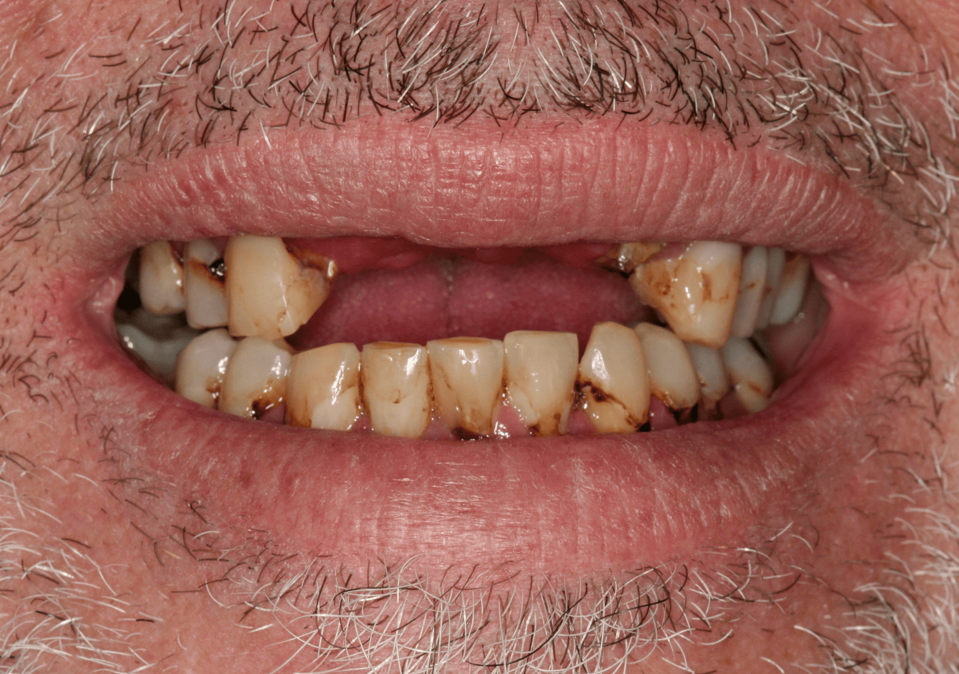 Oral Rehabilitation Case 2