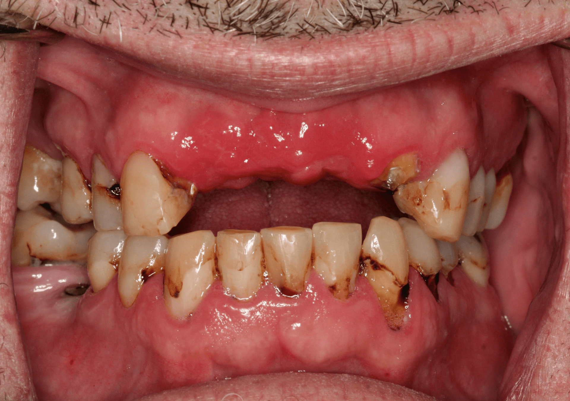 Oral Rehabilitation Case 2