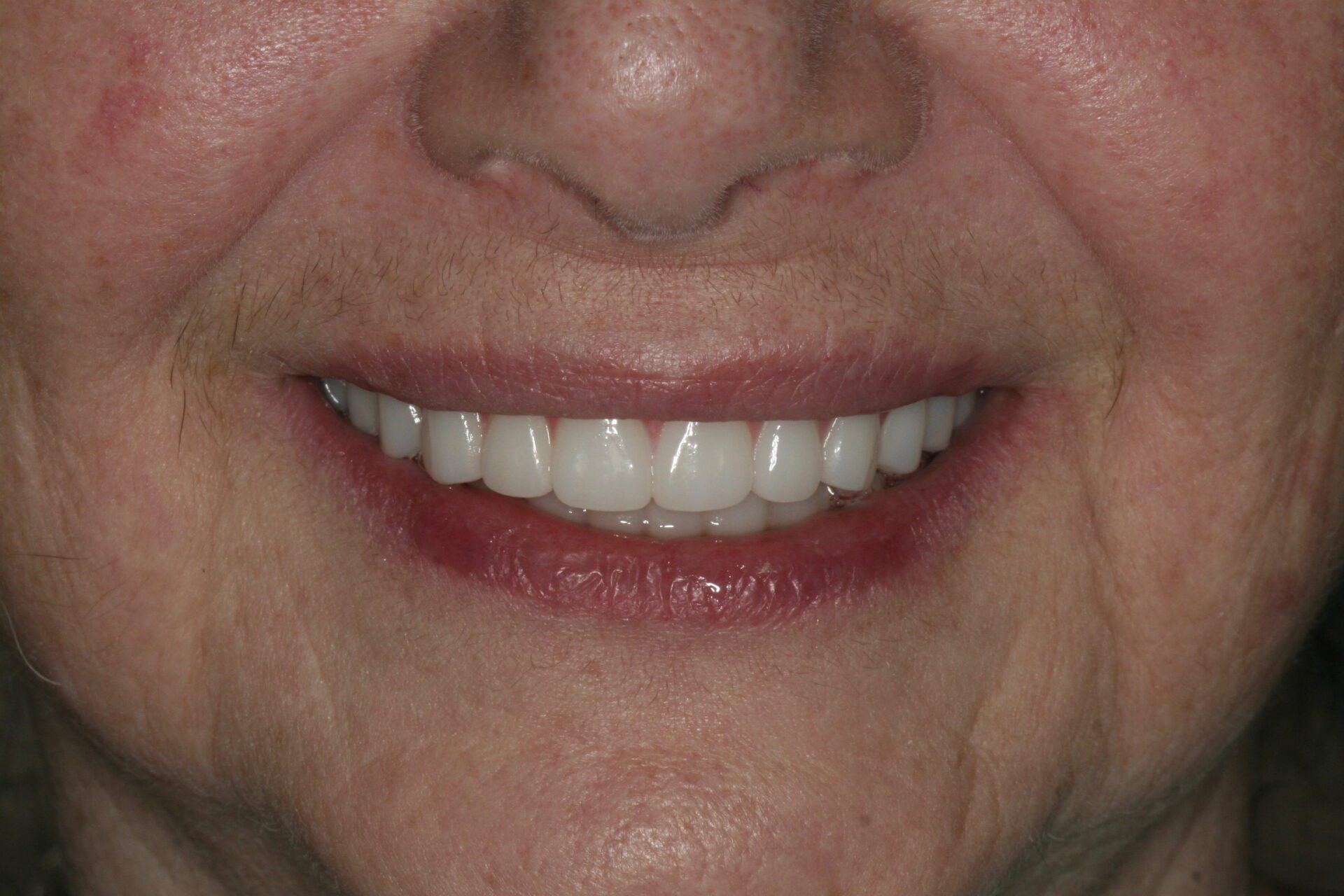 Dental Implants Case 3