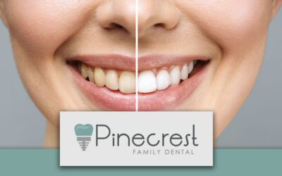 Zoom! Teeth Whitening: Discover a Radiant Smile at Pinecrest Family Dental