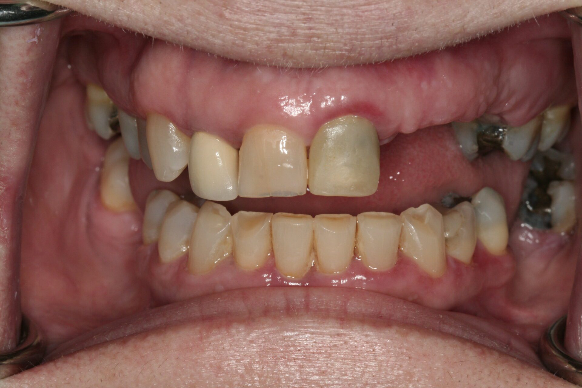 Oral Rehabilitation Case 3