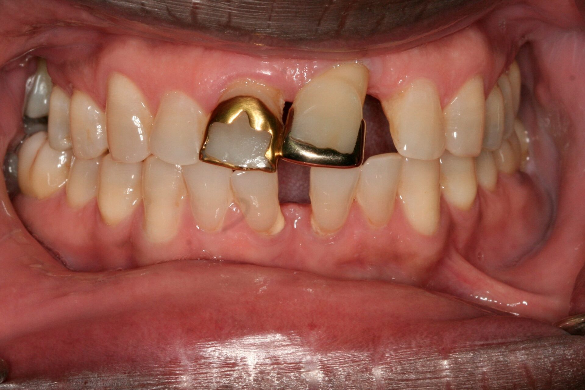 Oral Rehabilitation Case 3