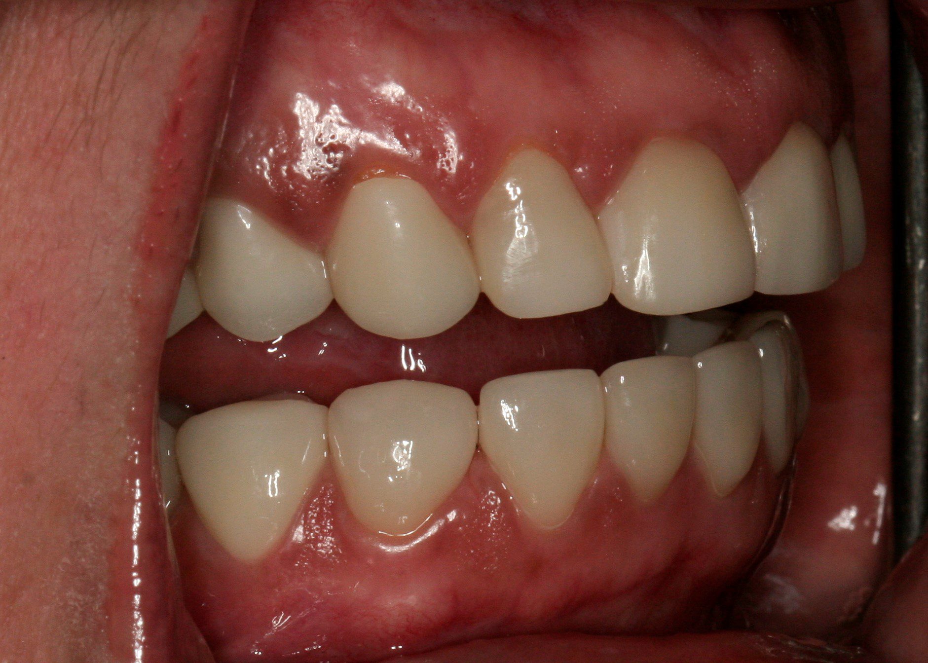 Oral Rehabilitation Case 3