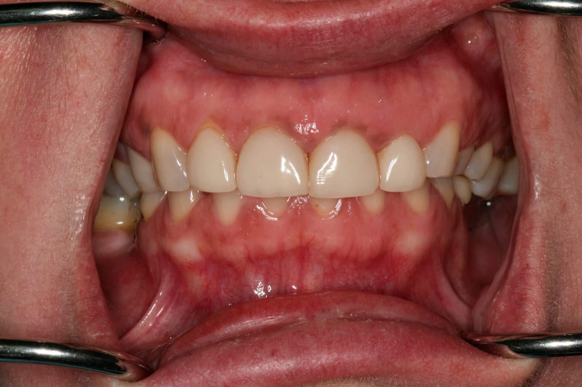 Oral Rehabilitation Case 3